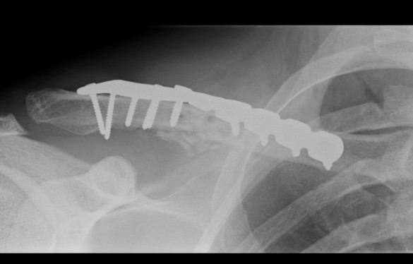 Clavicle Plate